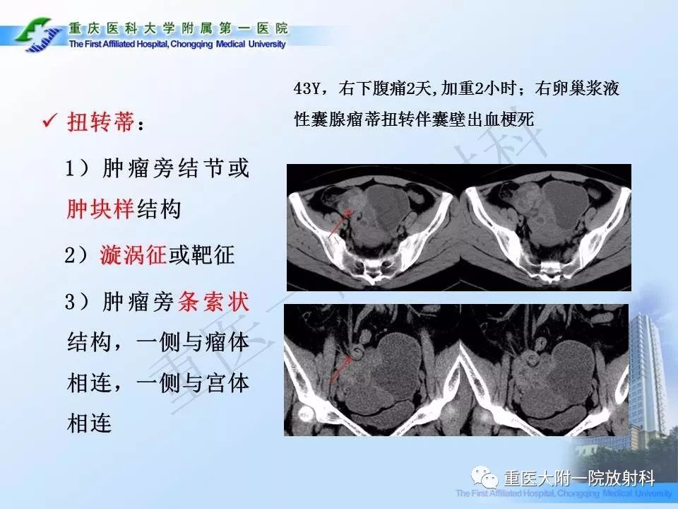 【PPT】卵巢肿瘤蒂扭转的CT诊断