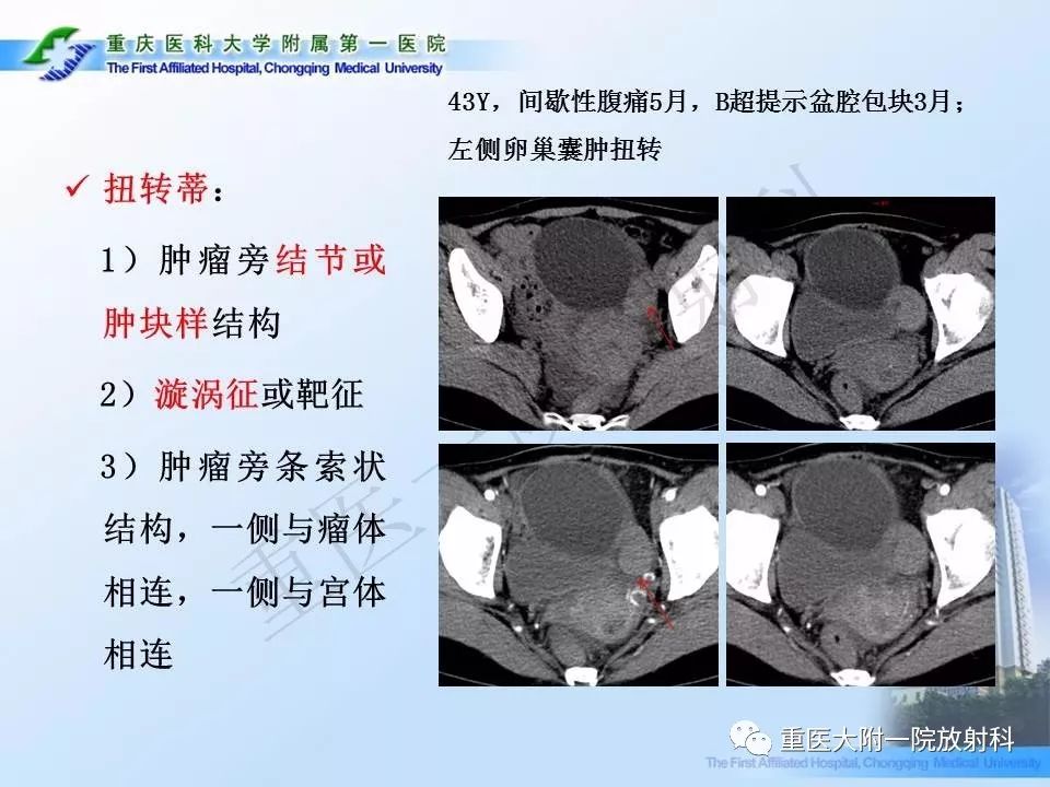 【PPT】卵巢肿瘤蒂扭转的CT诊断
