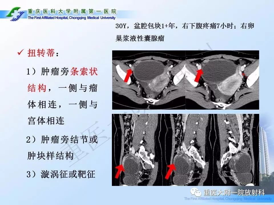 【PPT】卵巢肿瘤蒂扭转的CT诊断