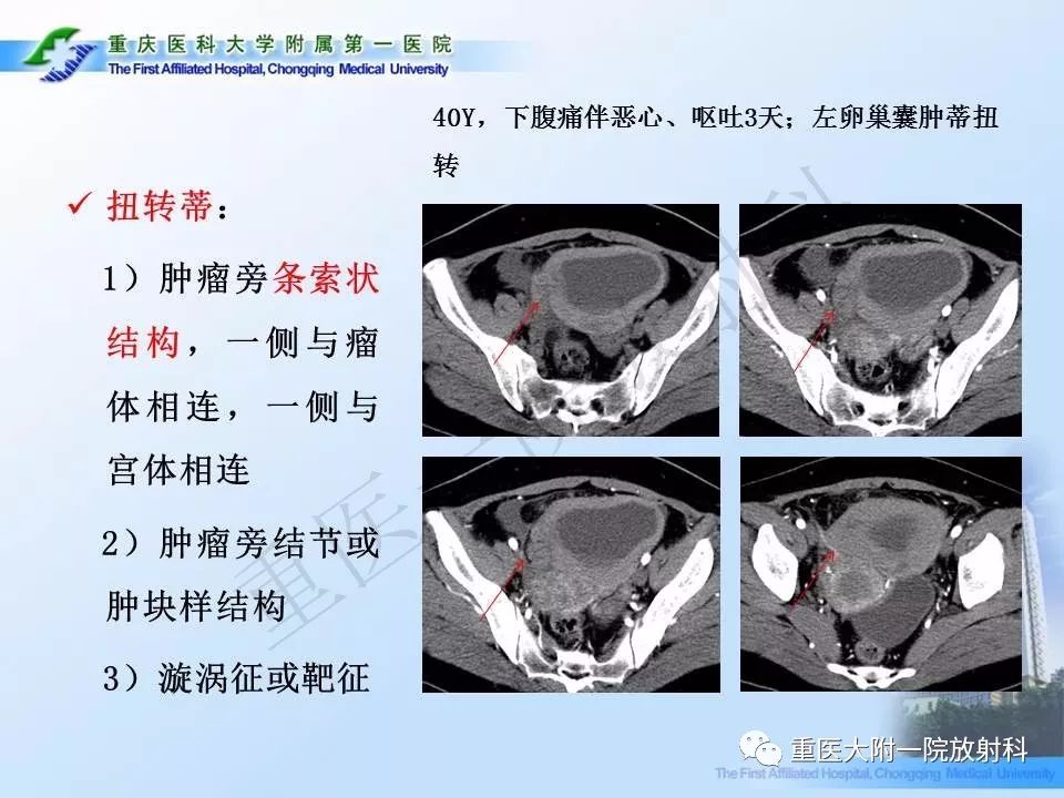 【PPT】卵巢肿瘤蒂扭转的CT诊断