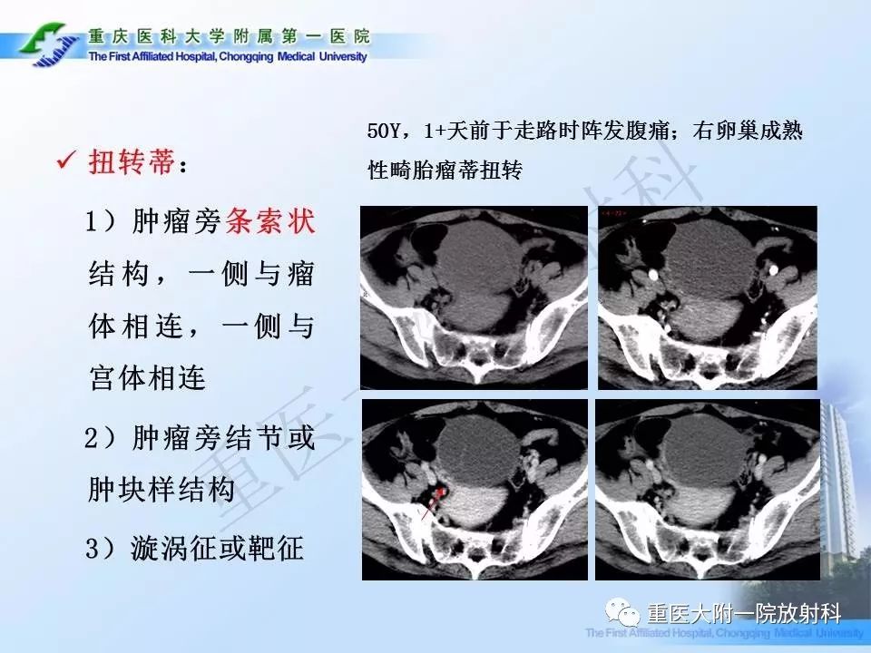 【PPT】卵巢肿瘤蒂扭转的CT诊断