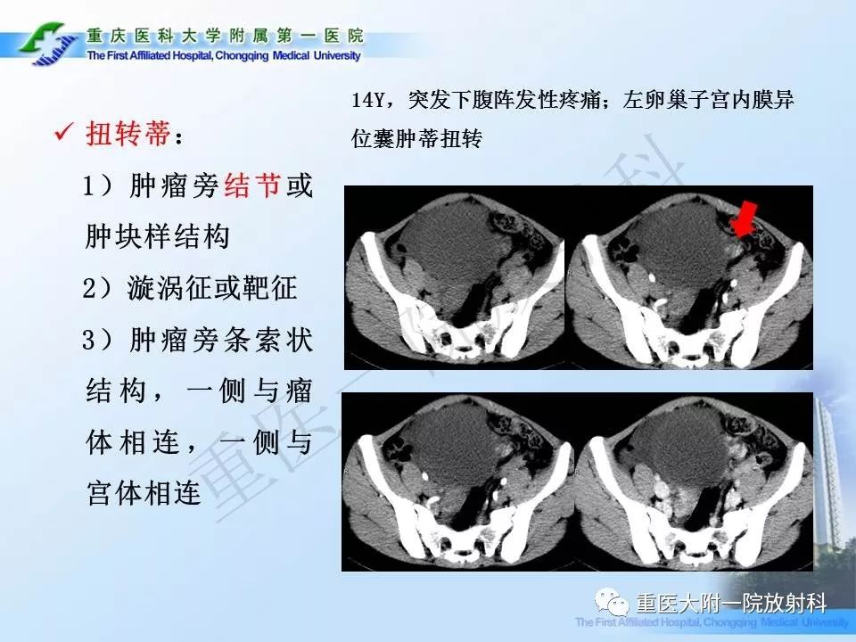 【PPT】卵巢肿瘤蒂扭转的CT诊断