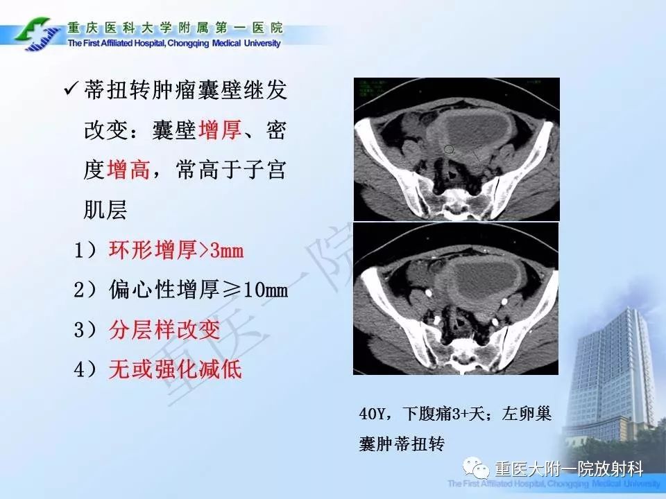 【PPT】卵巢肿瘤蒂扭转的CT诊断