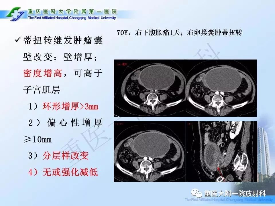 【PPT】卵巢肿瘤蒂扭转的CT诊断