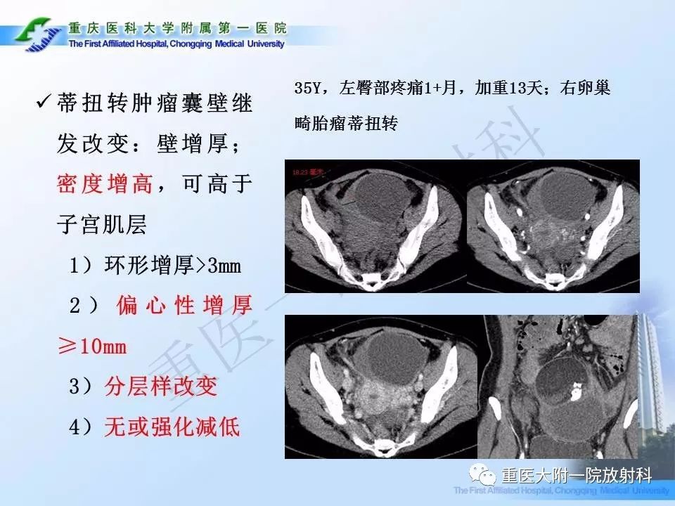 【PPT】卵巢肿瘤蒂扭转的CT诊断