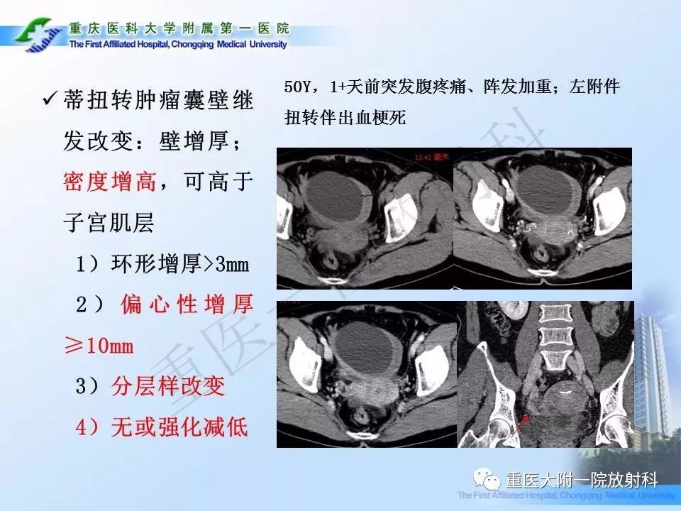 【PPT】卵巢肿瘤蒂扭转的CT诊断