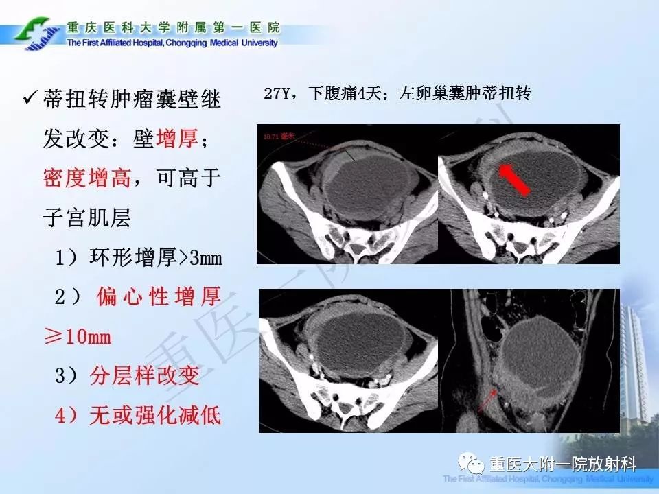 【PPT】卵巢肿瘤蒂扭转的CT诊断