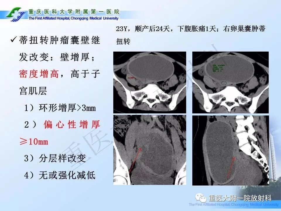 【PPT】卵巢肿瘤蒂扭转的CT诊断