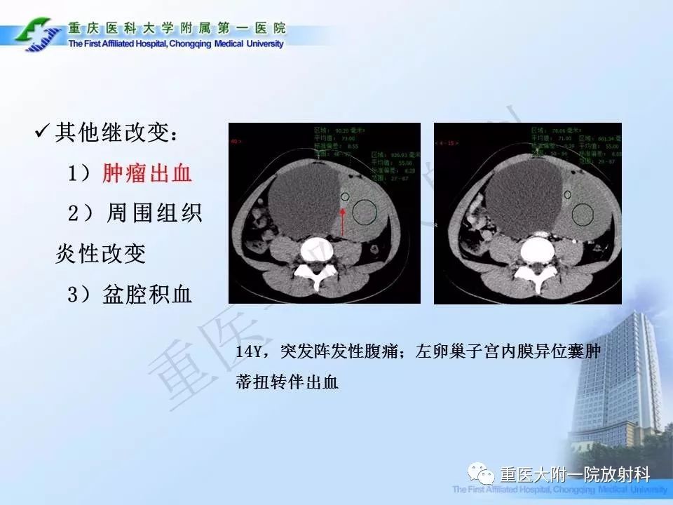 【PPT】卵巢肿瘤蒂扭转的CT诊断