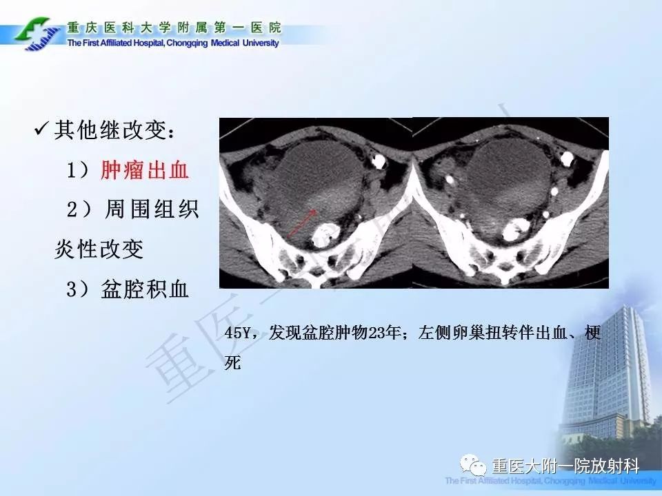 【PPT】卵巢肿瘤蒂扭转的CT诊断