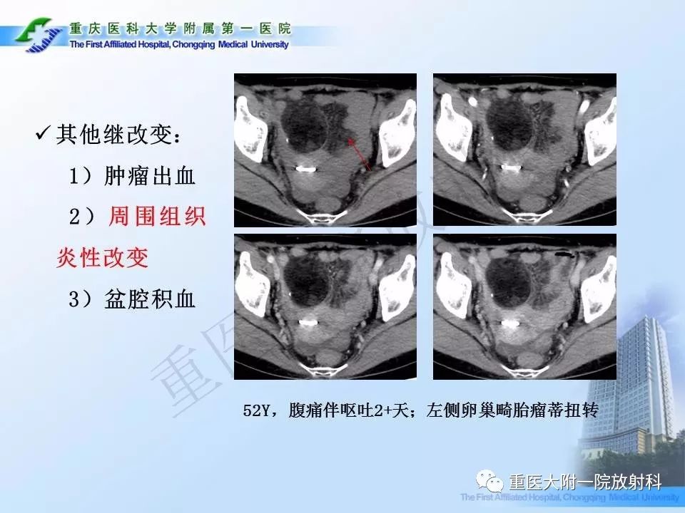 【PPT】卵巢肿瘤蒂扭转的CT诊断