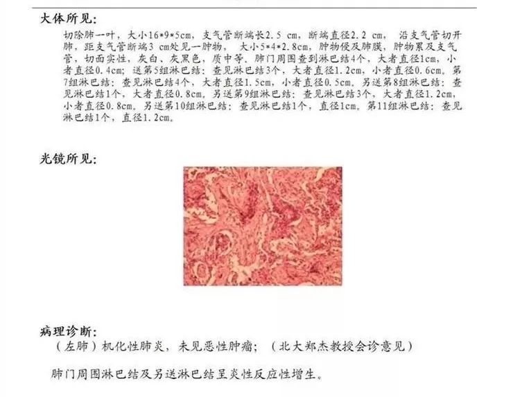 【病例】机化性肺炎1例CT影像 【病例】机化性肺炎1例CT影像