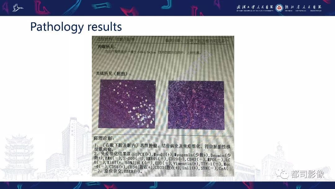 【PPT】眼眶胚胎性横纹肌肉瘤影像诊断