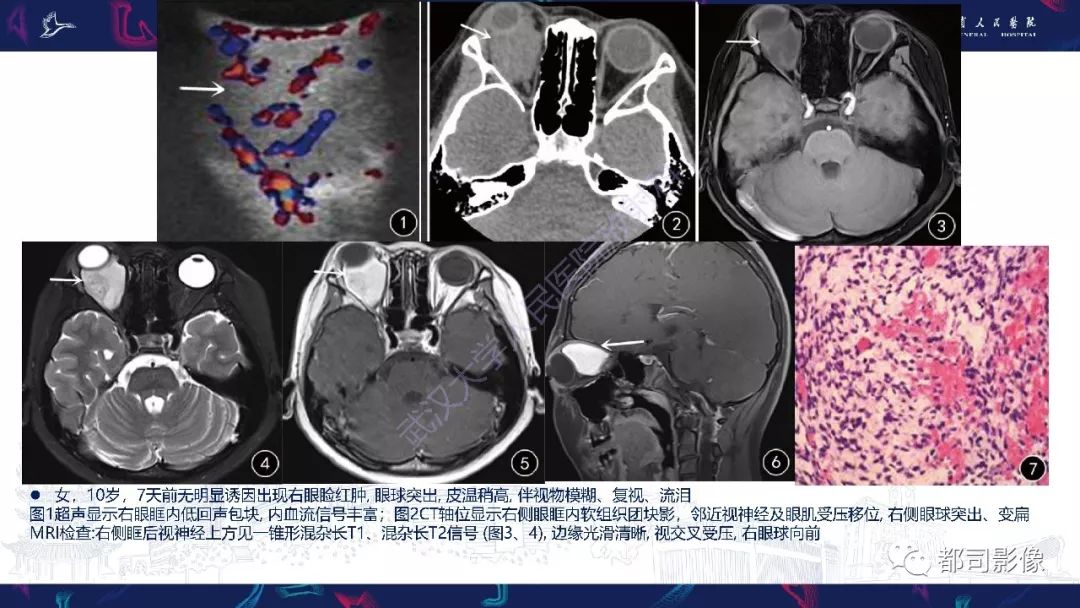 【PPT】眼眶胚胎性横纹肌肉瘤影像诊断
