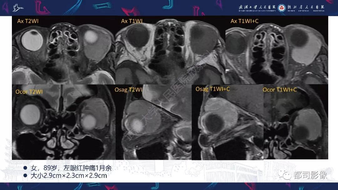 【PPT】眼眶胚胎性横纹肌肉瘤影像诊断