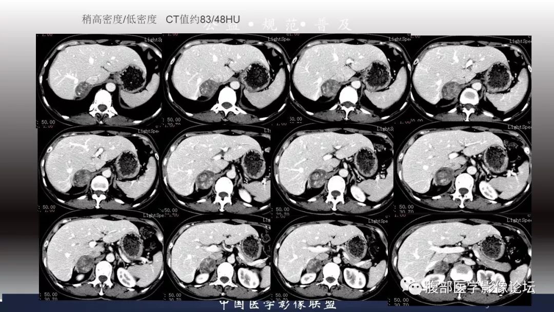 【病例】肾上腺皮质腺瘤1例CT影像