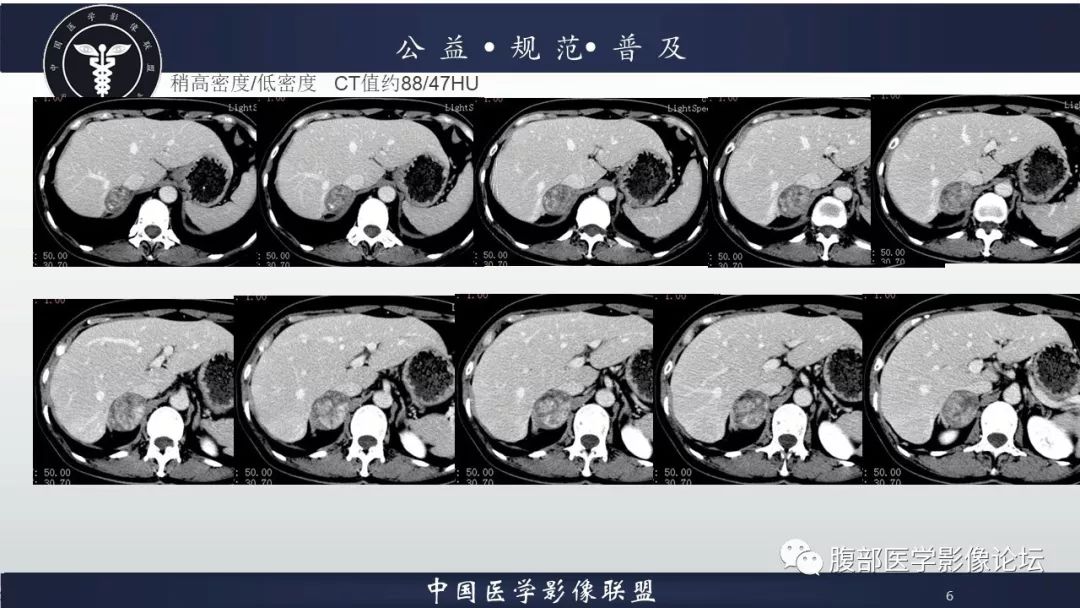 【病例】肾上腺皮质腺瘤1例CT影像