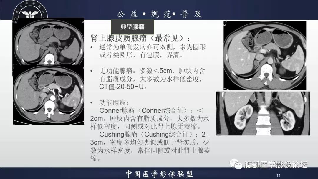 【病例】肾上腺皮质腺瘤1例CT影像