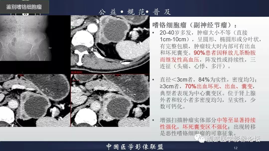 【病例】肾上腺皮质腺瘤1例CT影像