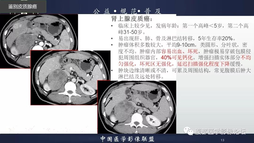 【病例】肾上腺皮质腺瘤1例CT影像