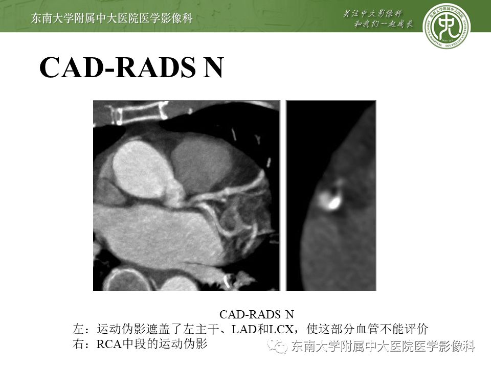 【PPT】冠脉疾病-报告和数据系统易混淆点