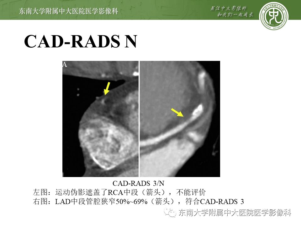 【PPT】冠脉疾病-报告和数据系统易混淆点