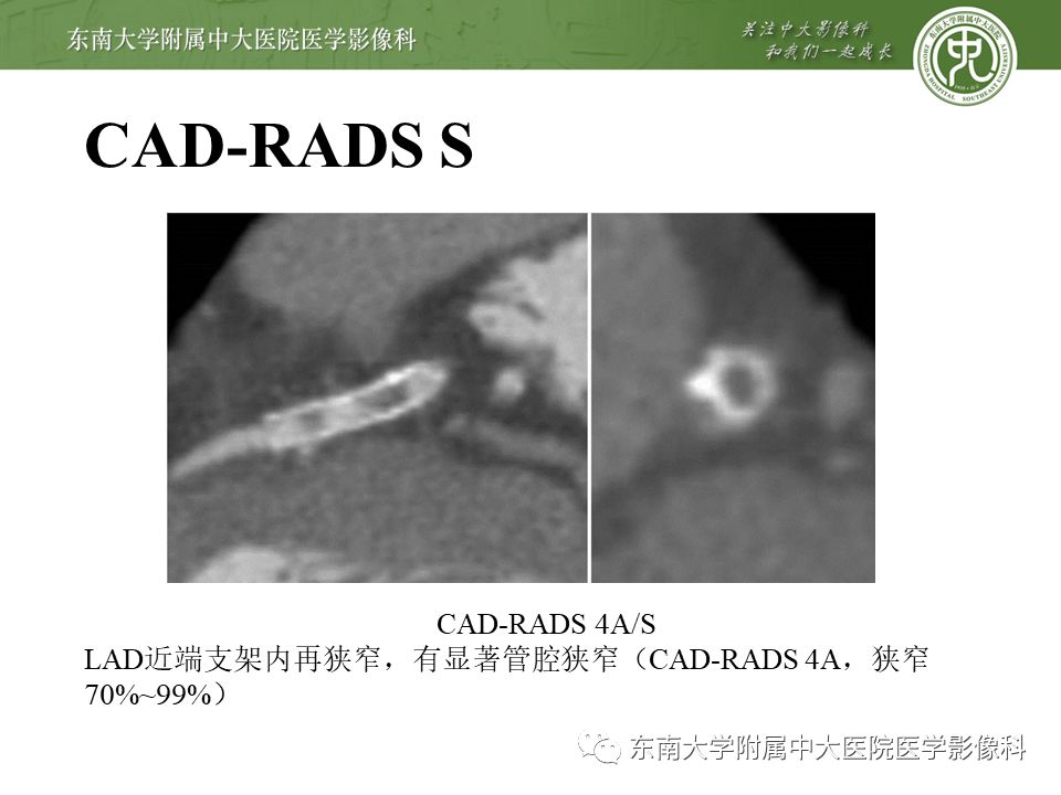 【PPT】冠脉疾病-报告和数据系统易混淆点