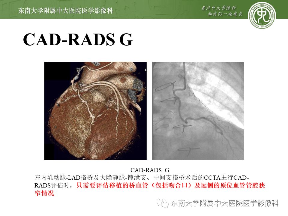 【PPT】冠脉疾病-报告和数据系统易混淆点
