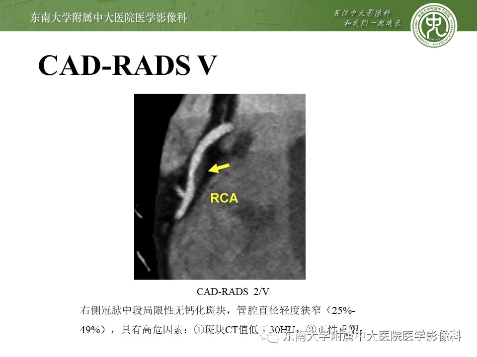 【PPT】冠脉疾病-报告和数据系统易混淆点