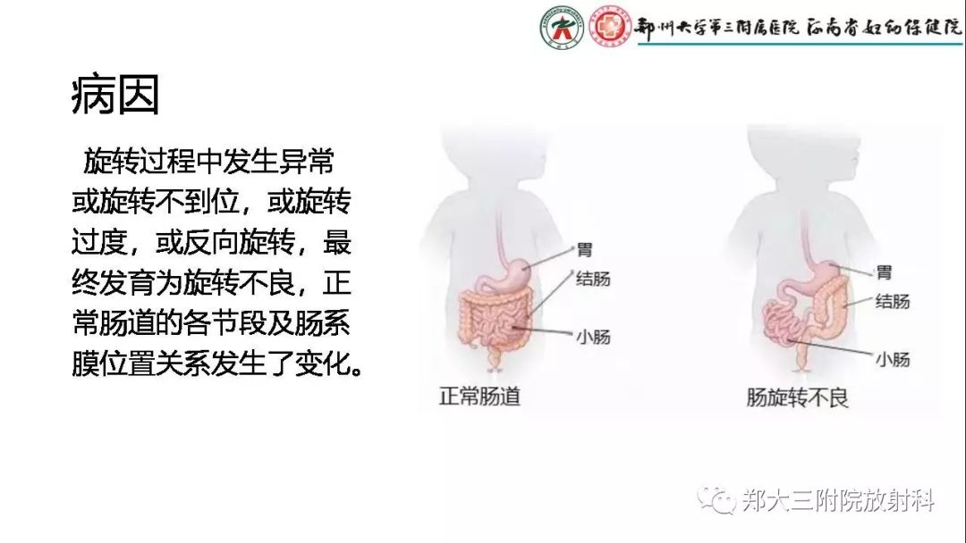 【PPT】先天性肠旋转不良的影像诊断