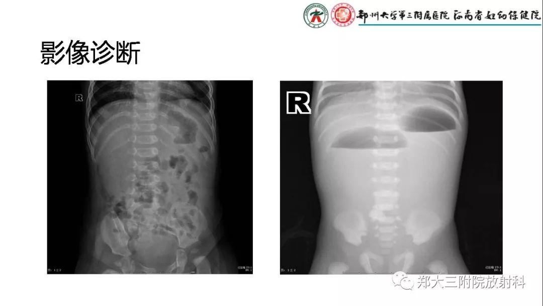 【PPT】先天性肠旋转不良的影像诊断