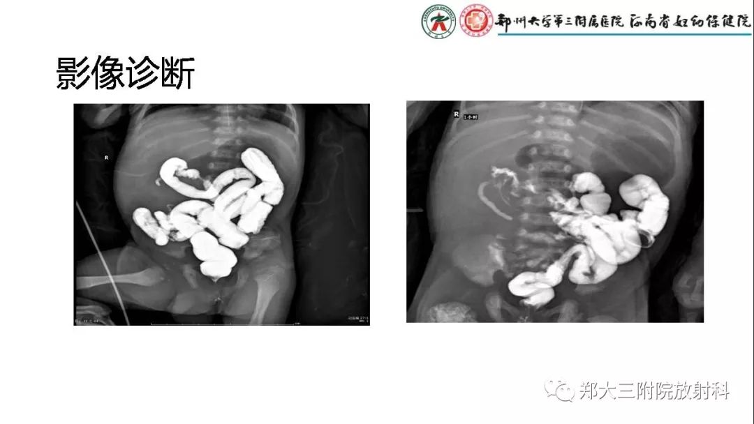 【PPT】先天性肠旋转不良的影像诊断