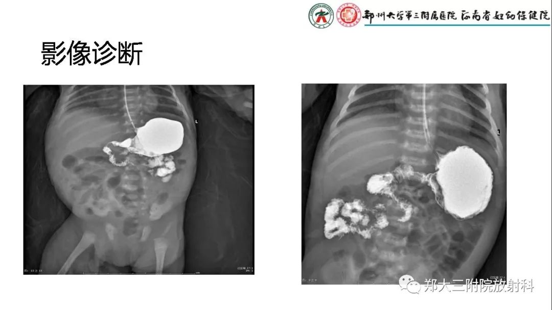 【PPT】先天性肠旋转不良的影像诊断