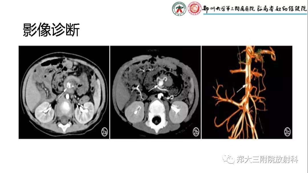 【PPT】先天性肠旋转不良的影像诊断