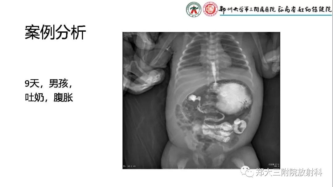 【PPT】先天性肠旋转不良的影像诊断