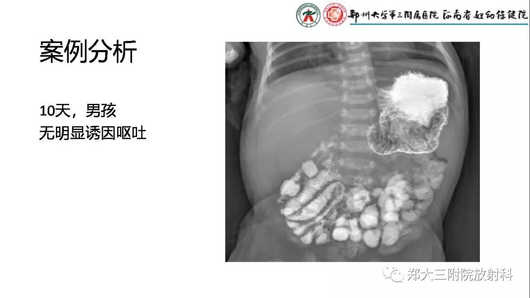 【PPT】先天性肠旋转不良的影像诊断