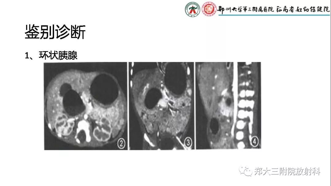 【PPT】先天性肠旋转不良的影像诊断