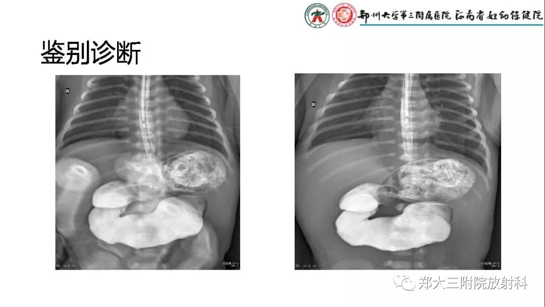 【PPT】先天性肠旋转不良的影像诊断