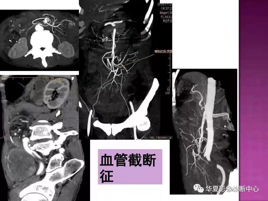 【PPT】小肠梗阻的CT诊断—肠梗阻的梗阻点的寻找
