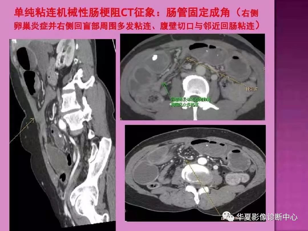 【PPT】小肠梗阻的CT诊断—肠梗阻的梗阻点的寻找