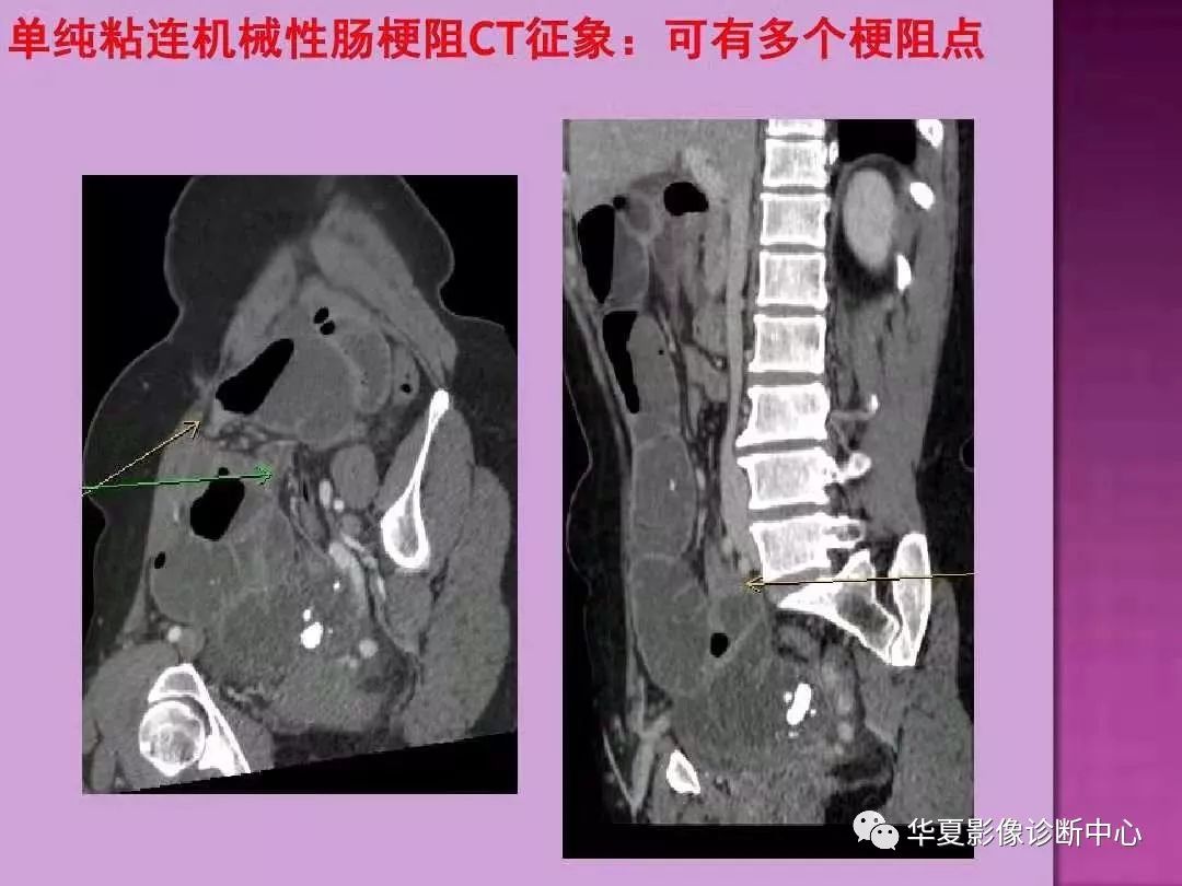 【PPT】小肠梗阻的CT诊断—肠梗阻的梗阻点的寻找
