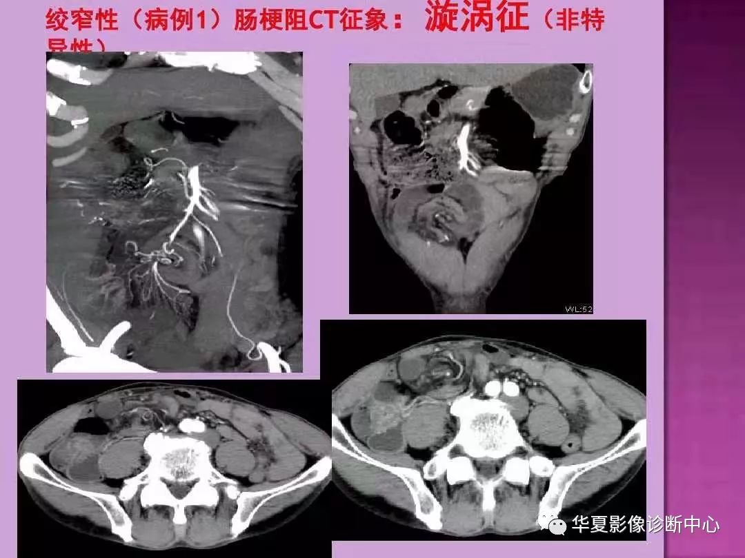 【PPT】小肠梗阻的CT诊断—肠梗阻的梗阻点的寻找