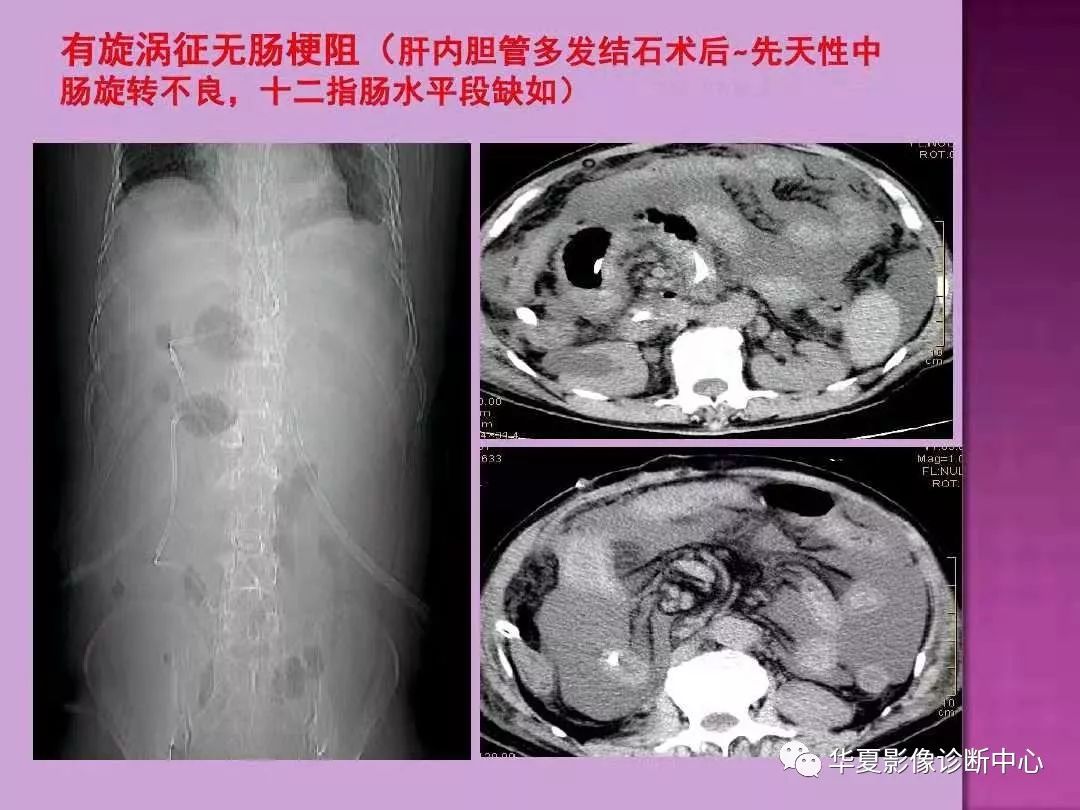 【PPT】小肠梗阻的CT诊断—肠梗阻的梗阻点的寻找