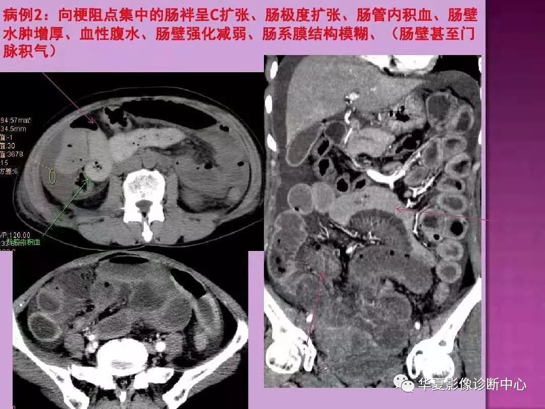 【PPT】小肠梗阻的CT诊断—肠梗阻的梗阻点的寻找