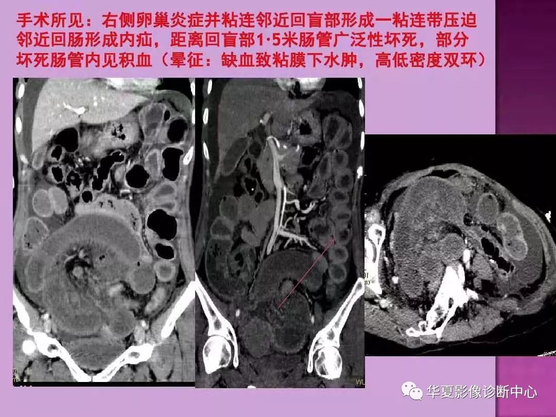【PPT】小肠梗阻的CT诊断—肠梗阻的梗阻点的寻找