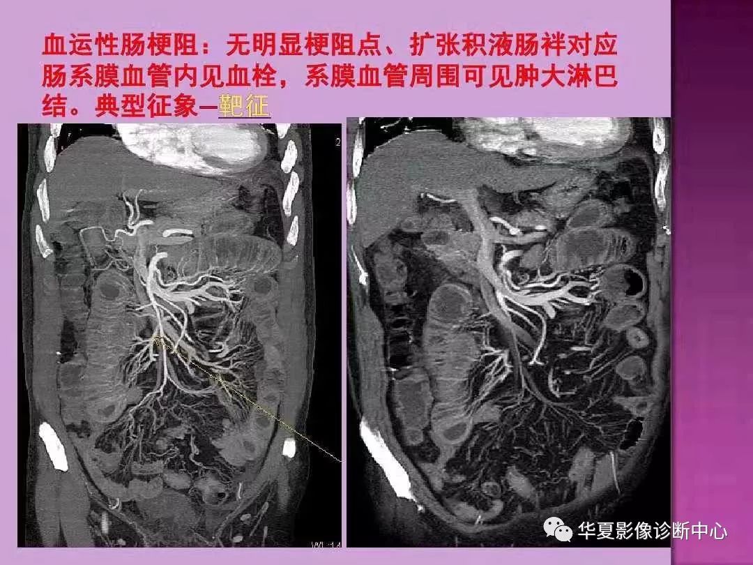 【PPT】小肠梗阻的CT诊断—肠梗阻的梗阻点的寻找