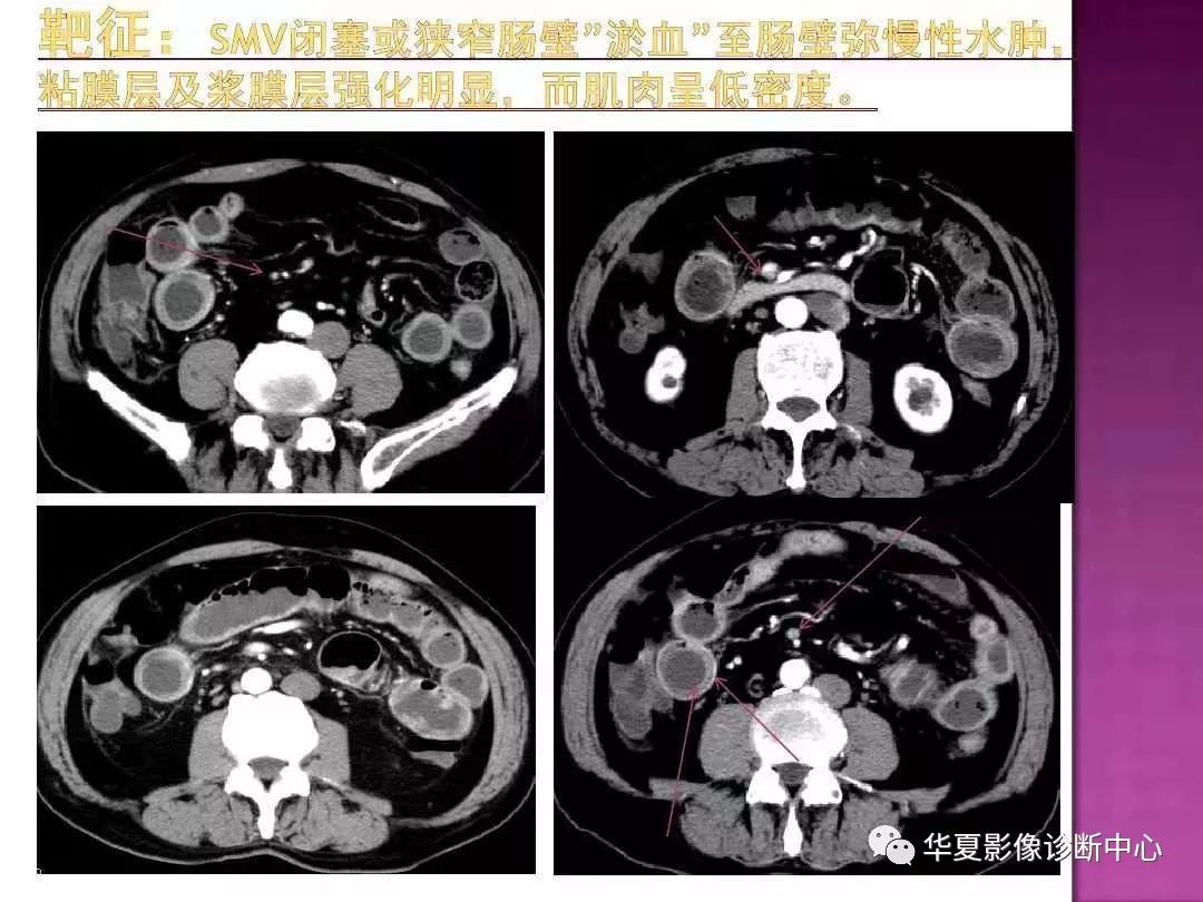 【PPT】小肠梗阻的CT诊断—肠梗阻的梗阻点的寻找