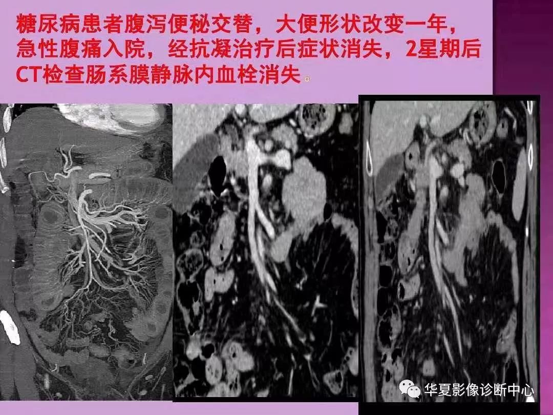 【PPT】小肠梗阻的CT诊断—肠梗阻的梗阻点的寻找