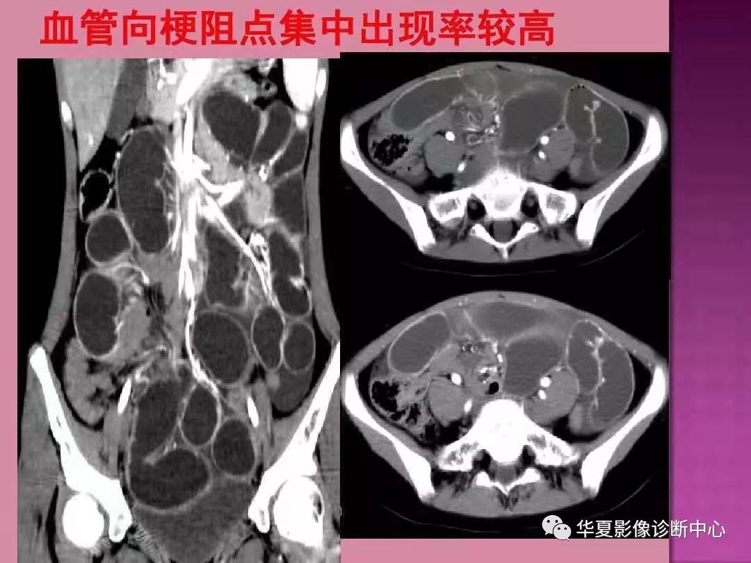 【PPT】小肠梗阻的CT诊断—肠梗阻的梗阻点的寻找