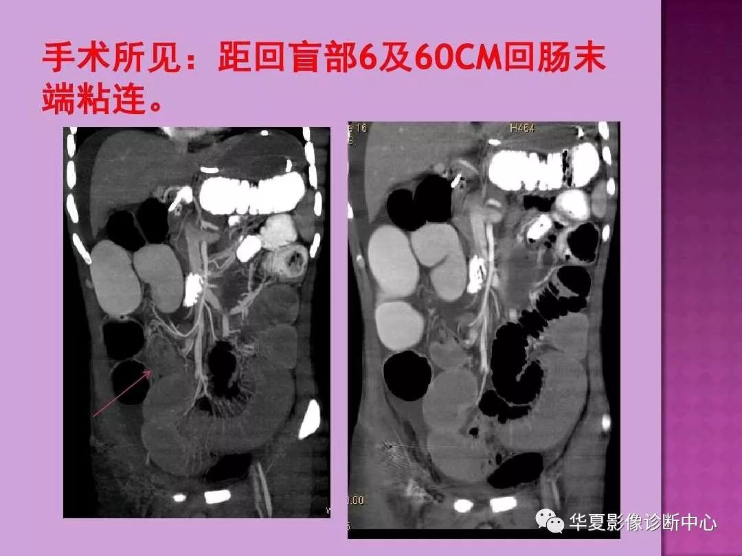 【PPT】小肠梗阻的CT诊断—肠梗阻的梗阻点的寻找